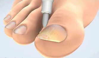 onychomycosis scraping bilduma