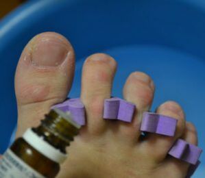 Azazkalak onddoen aurkako tantekin tratatzeko prestatzen